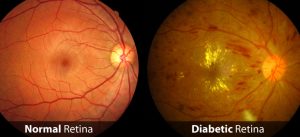 normal vs diabetic retinopathy